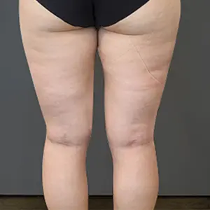 太もも BEFORE