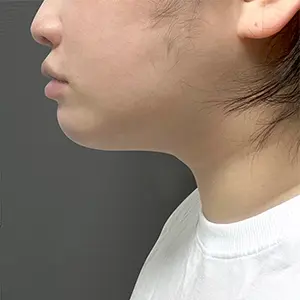 フェイスライン AFTER