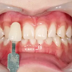 ホワイトニング AFTER