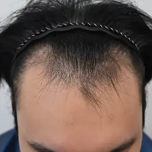 男性非切開（ヒドゥンカット）4,500株 BEFORE