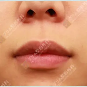 鼻下切開人中短縮 BEFORE