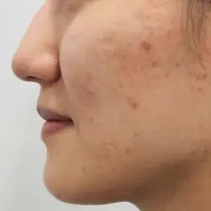 ポテンツァ＋ジュべルック BEFORE