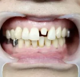 ラミネート BEFORE