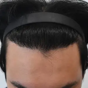 男性非切開（ヒドゥンカット）4,500株 AFTER