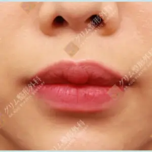 鼻下切開人中短縮 AFTER