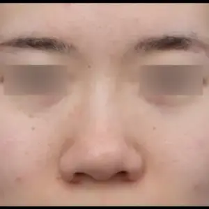 鼻整形 BEFORE