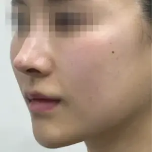 シルエットソフト AFTER