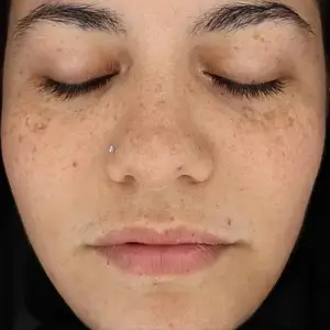 レブライト BEFORE