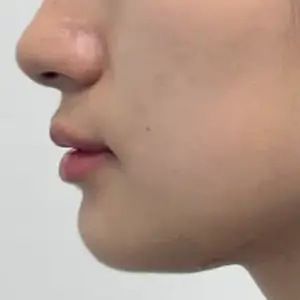 糸リフト＋フィラー BEFORE