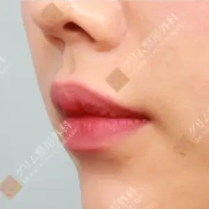 鼻下切開人中短縮 AFTER