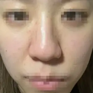 鼻整形 BEFORE