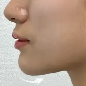 糸リフト＋フィラー AFTER