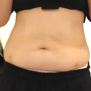 脂肪分解注射 AFTER