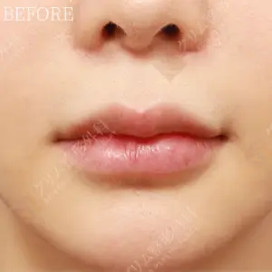鼻下切開人中短縮＋Cカール＋小鼻縮小 BEFORE