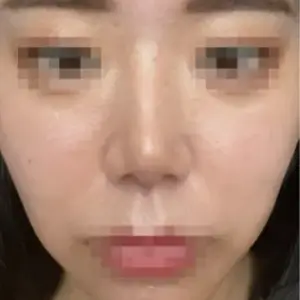 鼻整形 AFTER