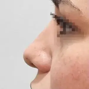 鼻フィラー（ベロテロ） BEFORE