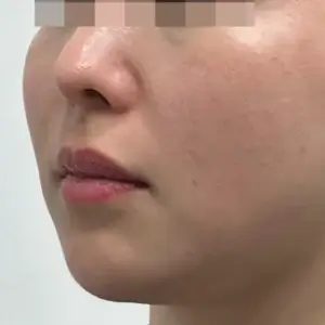 オンダリフト BEFORE