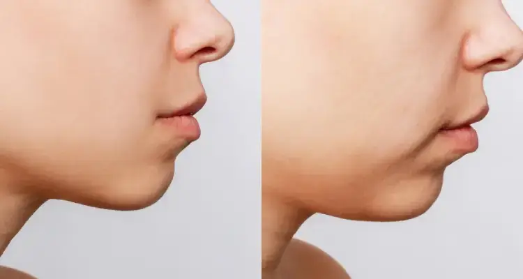 エラボトックス