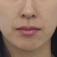 スカルトラ BEFORE