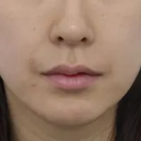 スカルトラ AFTER