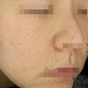 ニキビ治療 BEFORE