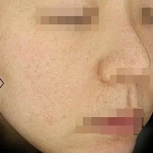 ニキビ治療 AFTER