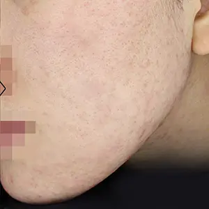 ニキビ治療 AFTER