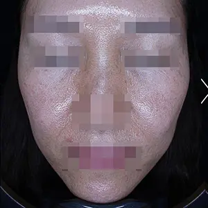 リフティング BEFORE