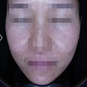 リフティング AFTER