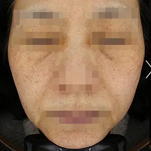 リフティング BEFORE