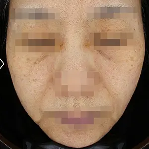 リフティング AFTER