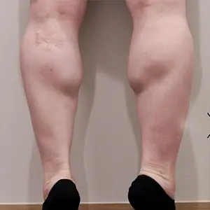 ふくらはぎ BEFORE