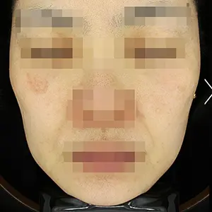 リフティング BEFORE