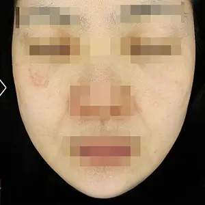 リフティング AFTER