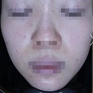 ニキビ治療 BEFORE