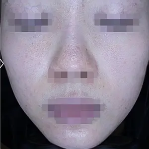 ニキビ治療 AFTER