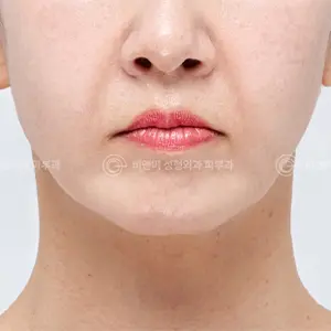 デュアルリフティング BEFORE