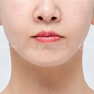 デュアルリフティング AFTER