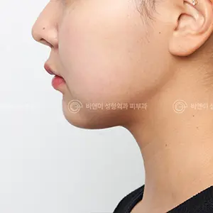 ポテンツァ AFTER