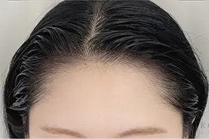 ヘアラインデザイン AFTER