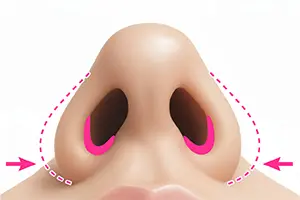 鼻中隔延長術