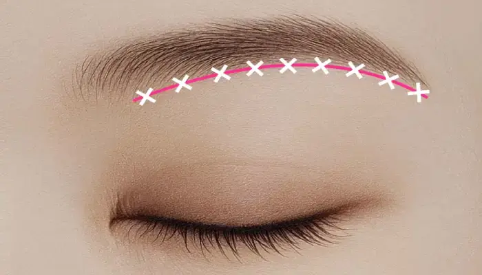 眉下リフト
