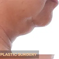 脂肪吸引（あご） BEFORE