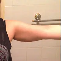 脂肪吸引（二の腕） BEFORE