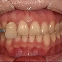 ホワイトニング BEFORE