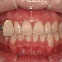 ホワイトニング AFTER