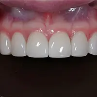 ラミネート AFTER