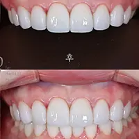 ラミネート AFTER