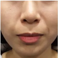 Vリフティング埋線 BEFORE