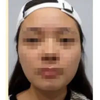 Vリフティング埋線 BEFORE